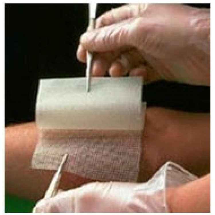 CHLORHEXIDINE GAUZE DRESSING